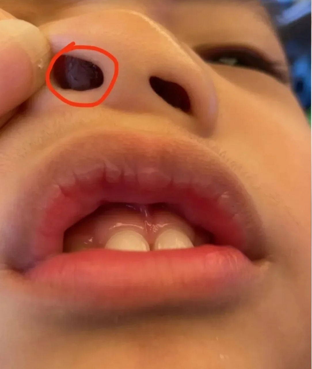 孩子睡觉老张口呼吸,到底是不是鼻窦炎腺样体肥大?