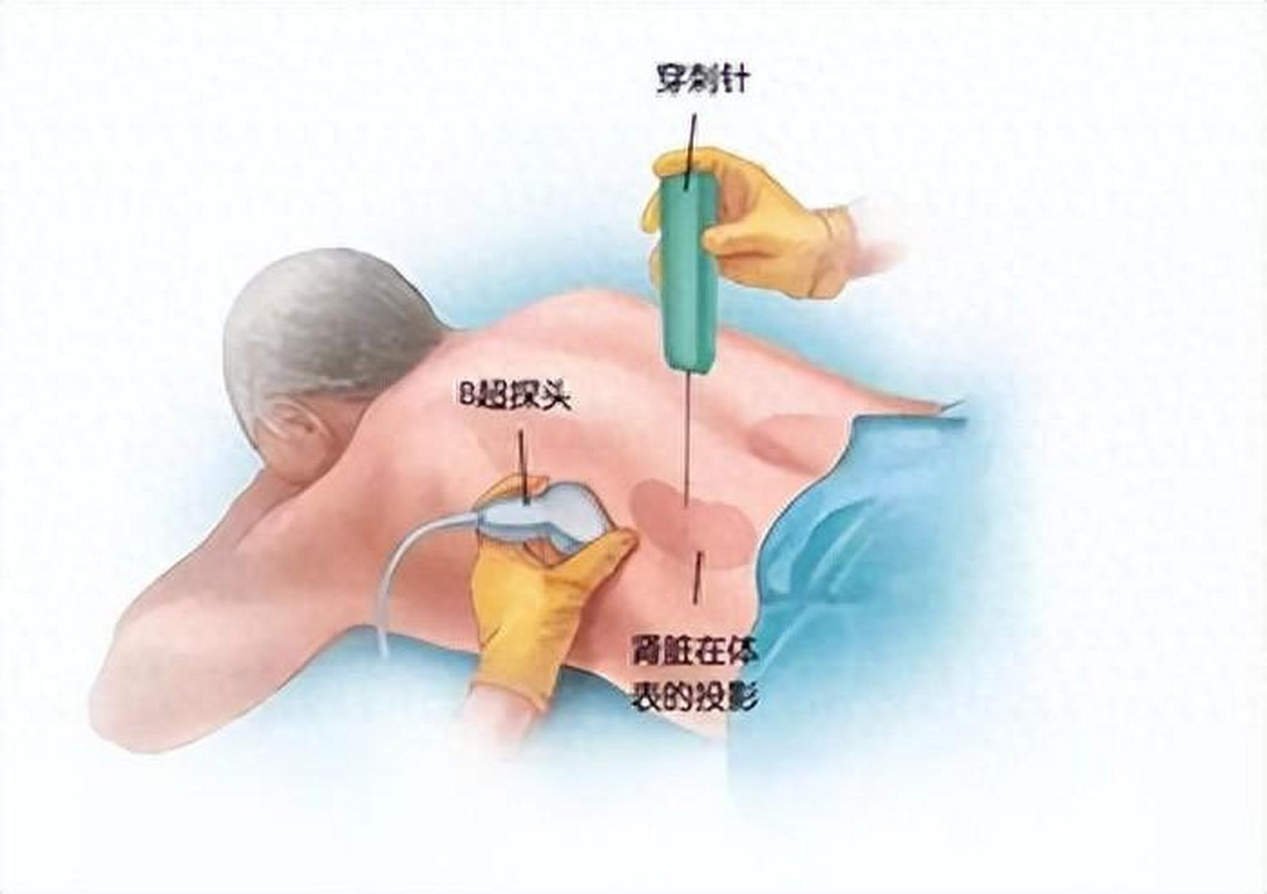 活检针使用方法图解图片