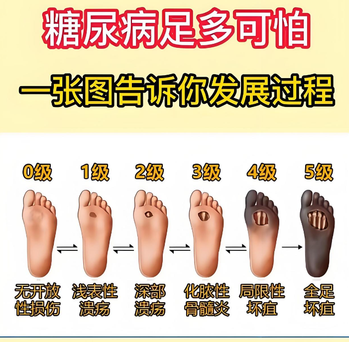 糖尿病它不光是血糖高那么简单,还老爱惹事儿,特别是糖尿病足,就是它