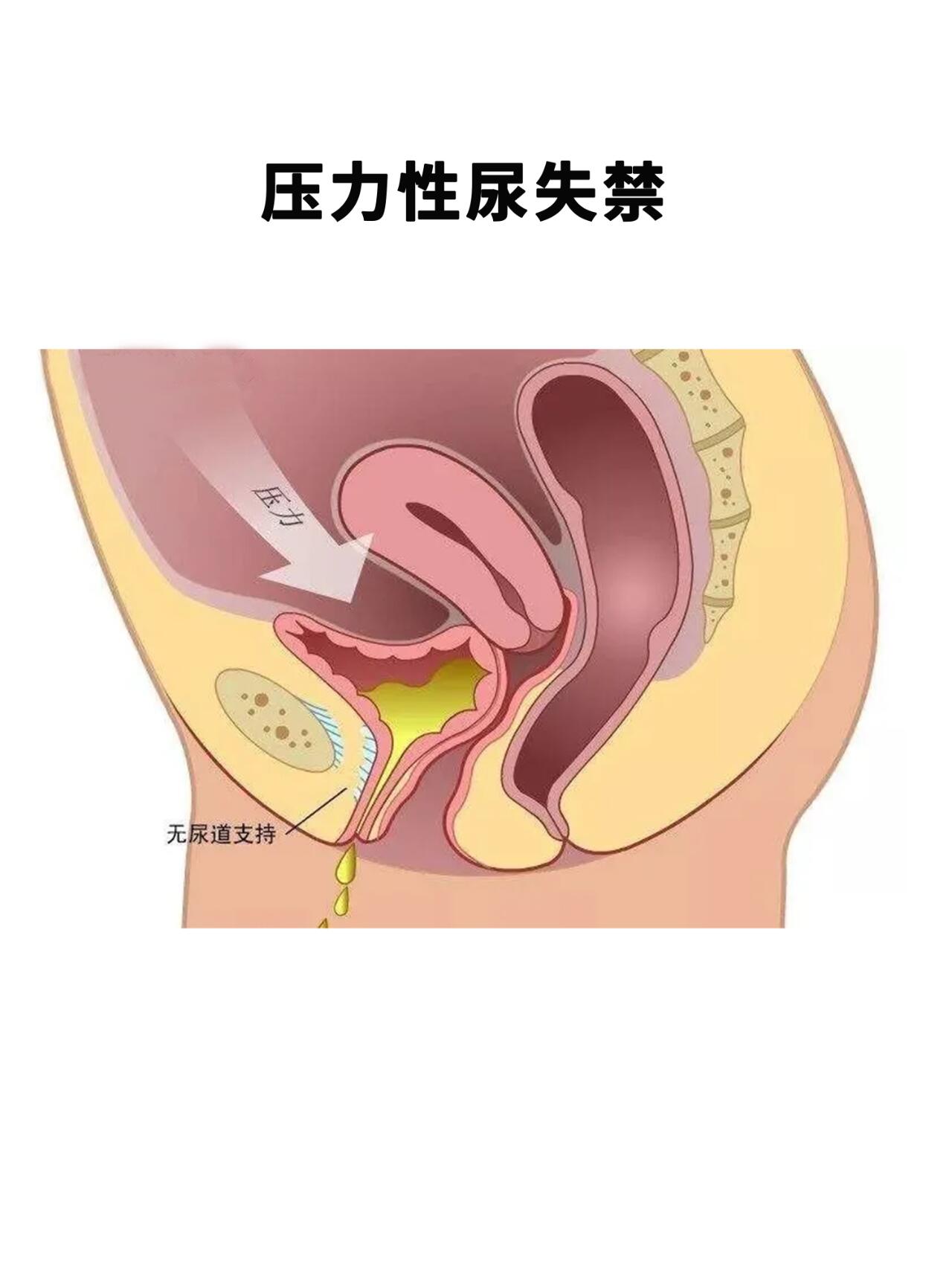 压力性尿失禁的常用手术方式| 患者54岁,常年咳嗽漏尿,搬重物的时候也