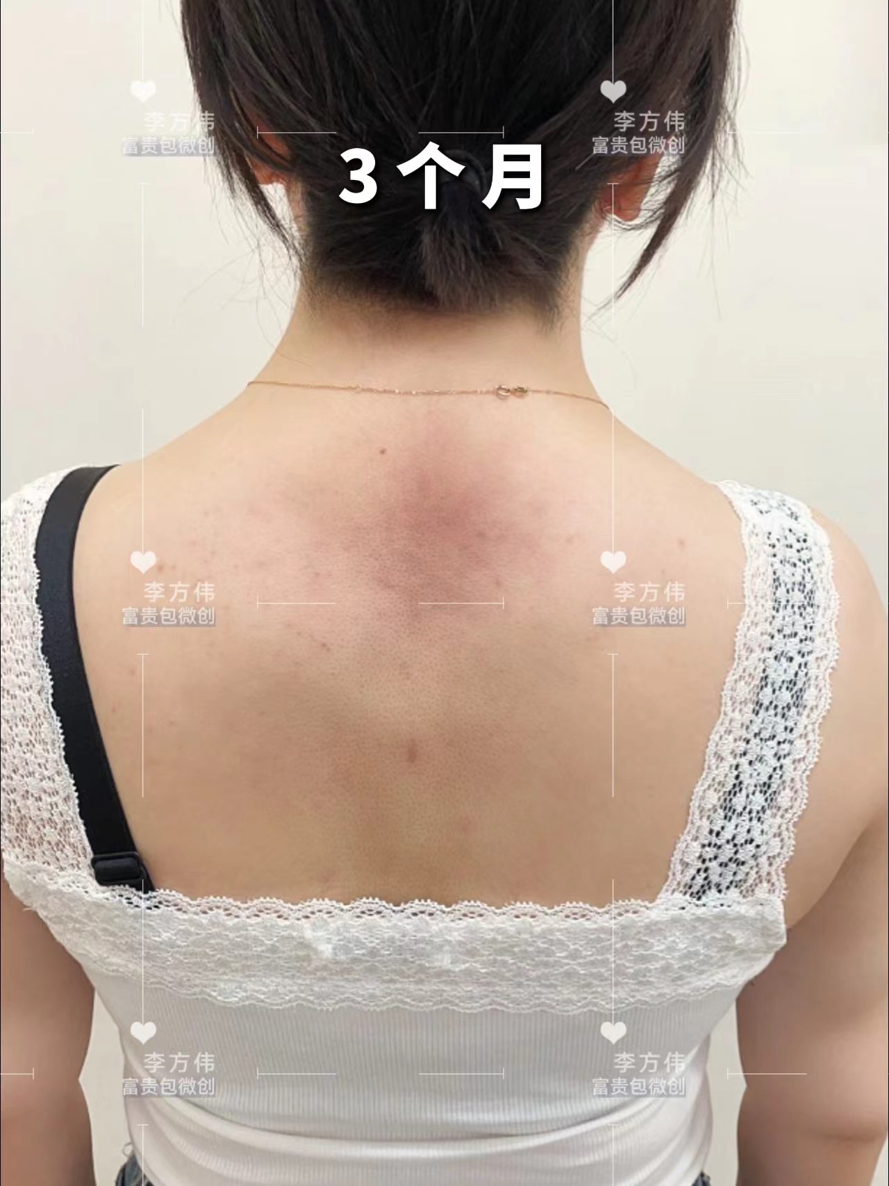 【富贵包微创·术后3个月】