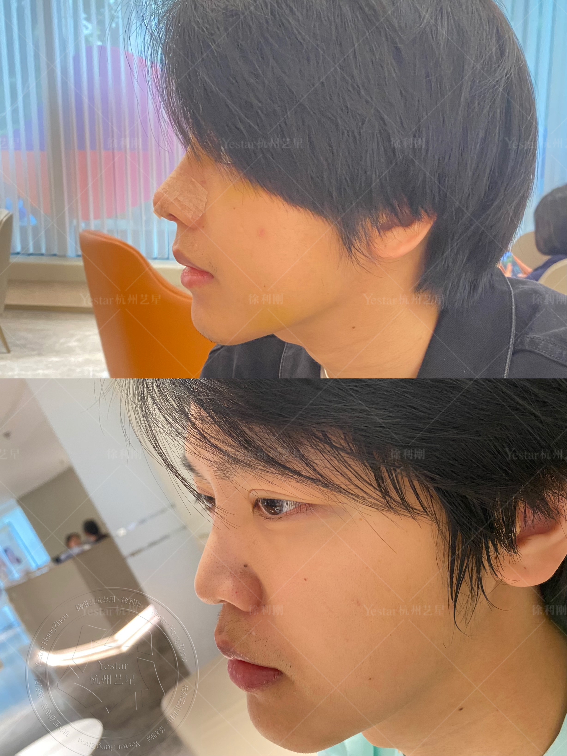 路人甲变身美男子 一整个大变样 面部立体起来了 #徐利刚肋软骨鼻综合