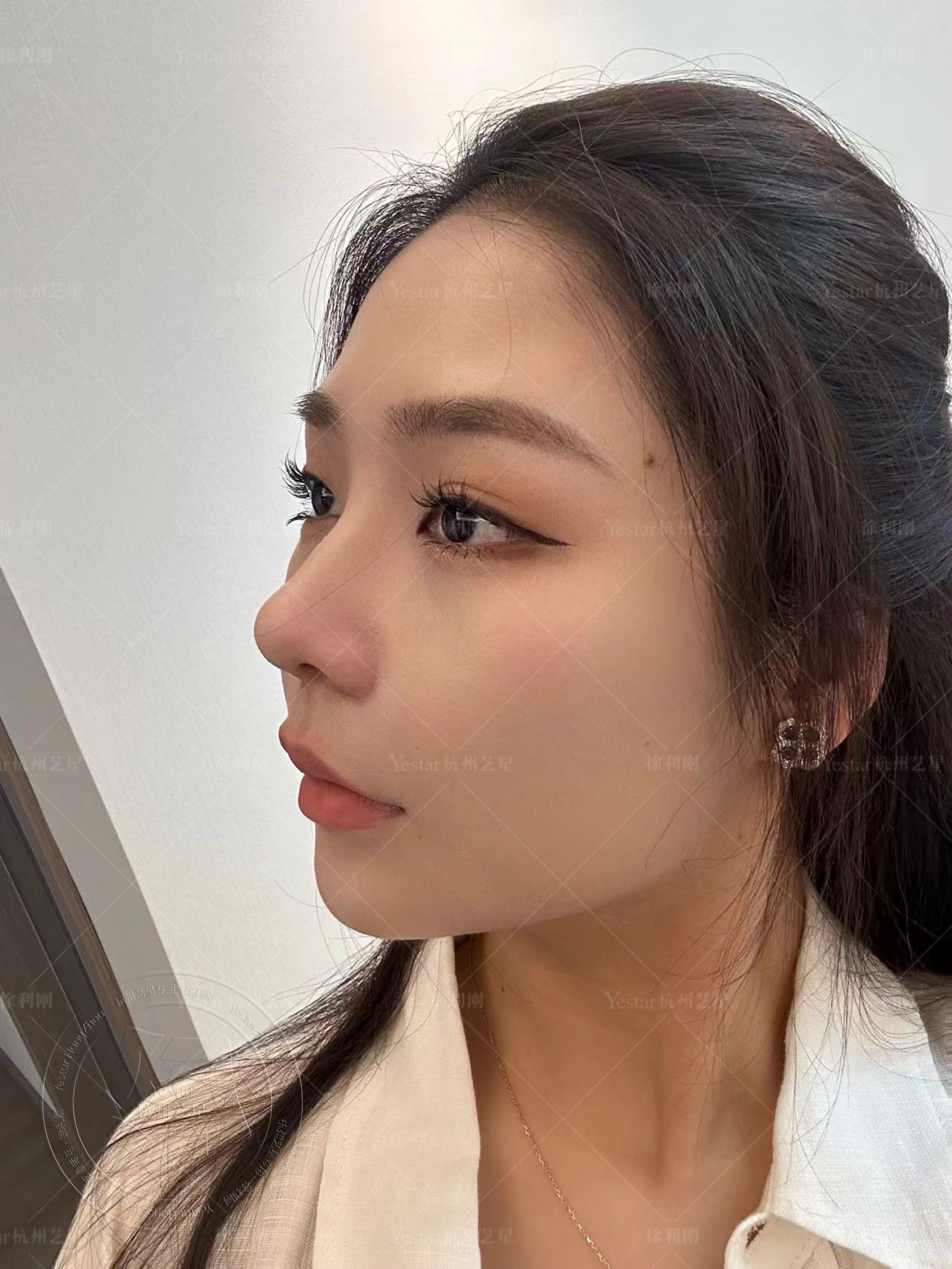 肋骨鼻术后20天 #徐利刚肋软骨鼻综合