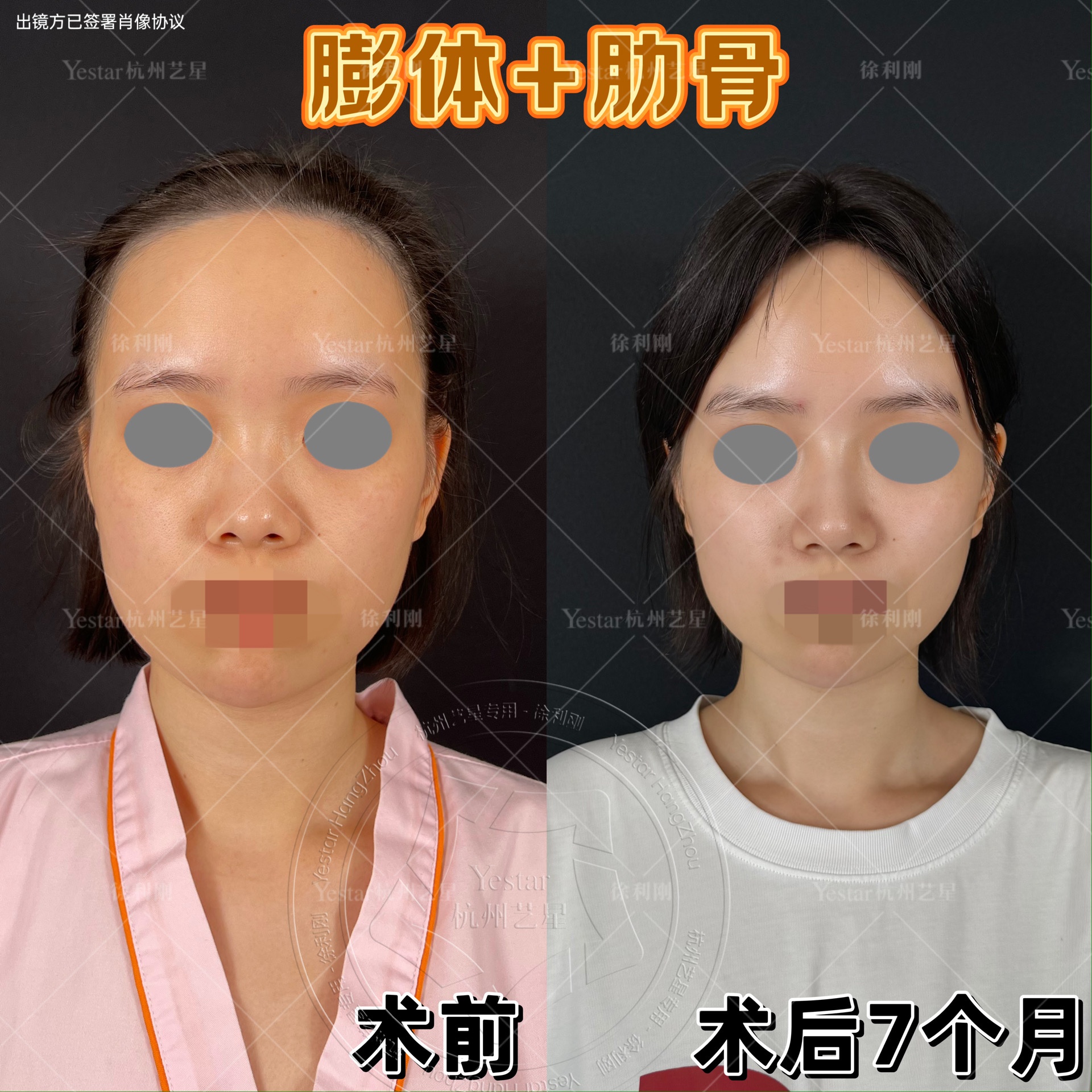 鼻拉长拉高 解决漏鼻孔问题 整体面部立体起来  #徐利刚肋软骨鼻综合