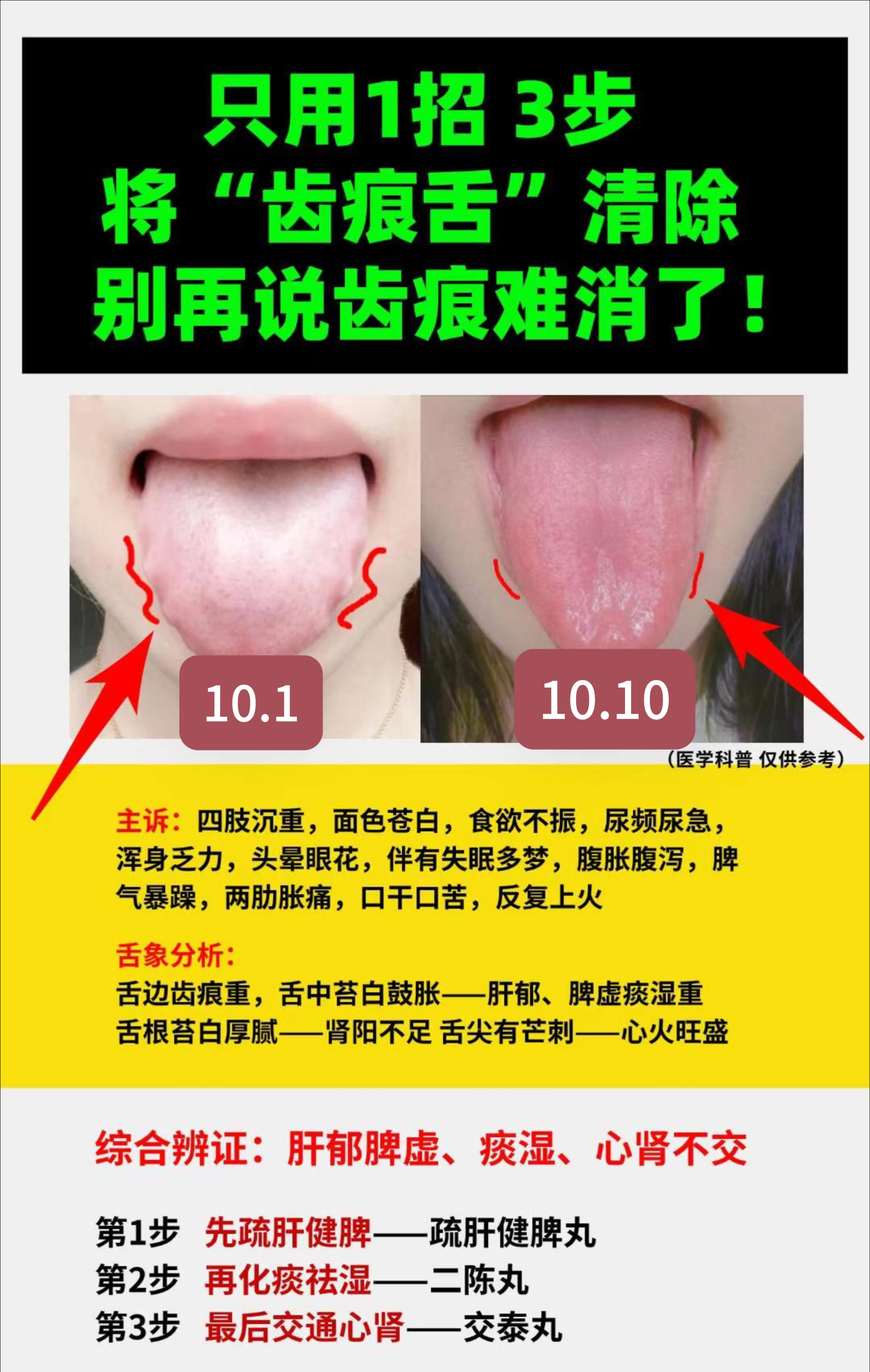 齿状线舌状上移图片