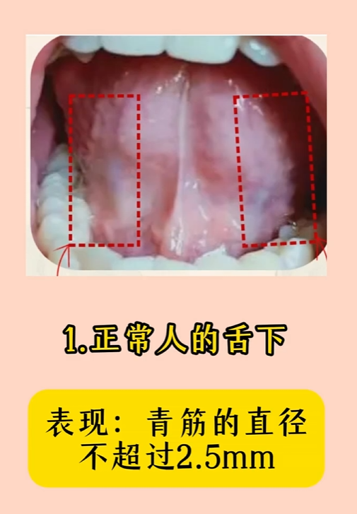 1.正常的舌下:青筋的直径不超过2