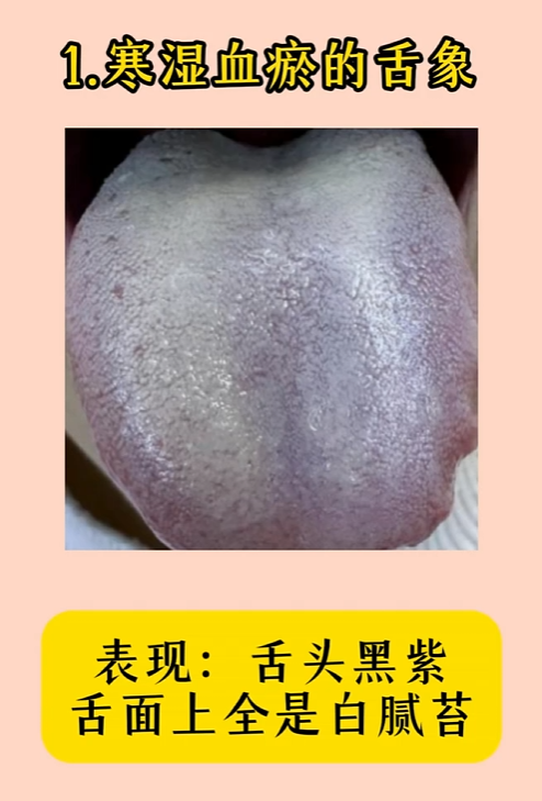 1.寒湿血瘀的舌象