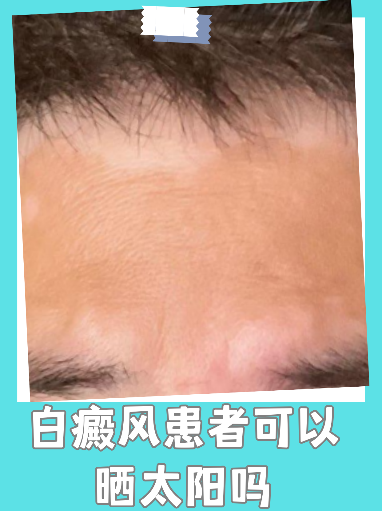 白癜风患者经常询问,他们是否可以晒太阳,阳光对