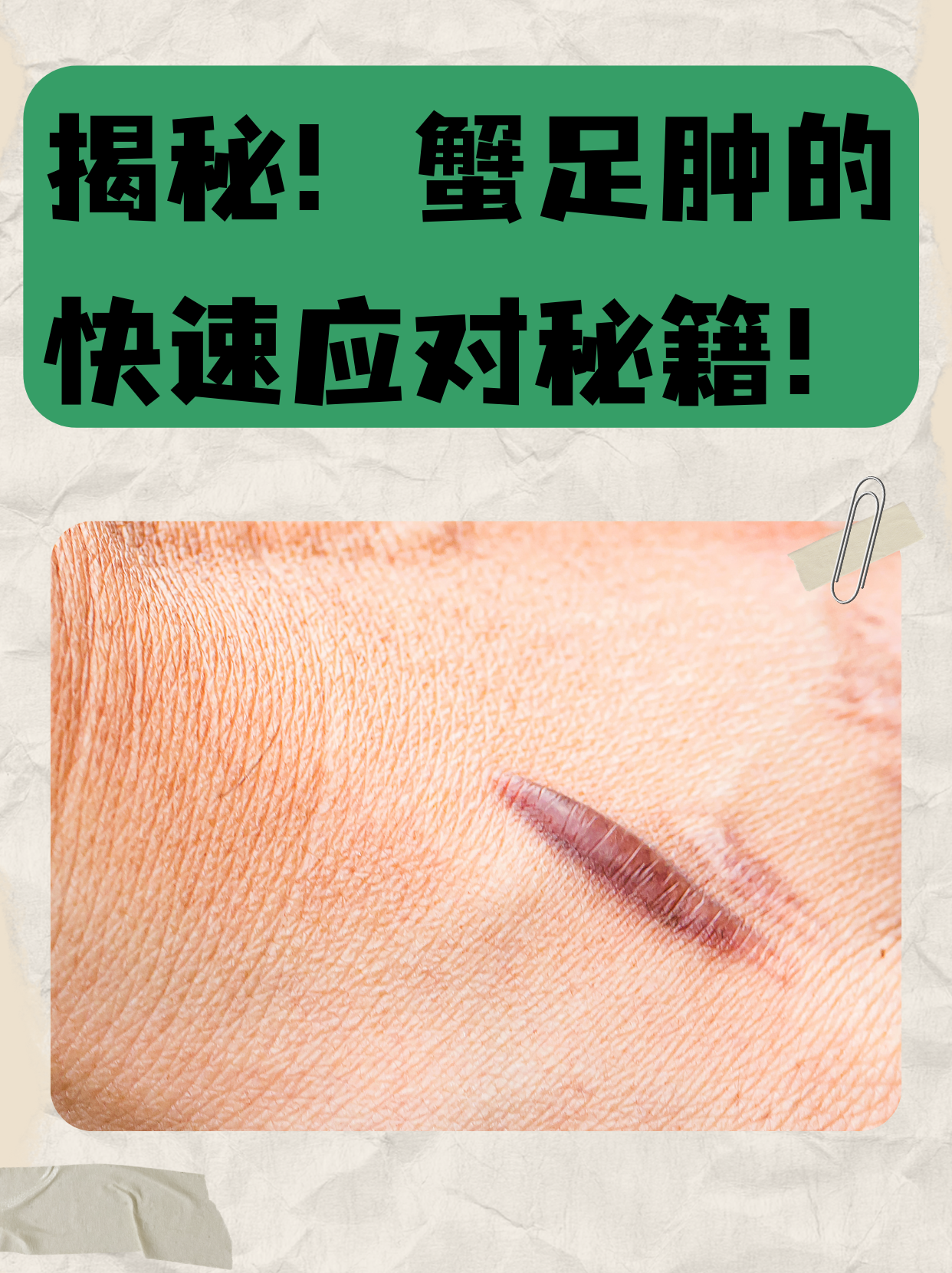 揭秘!蟹足肿的快速应对秘籍!