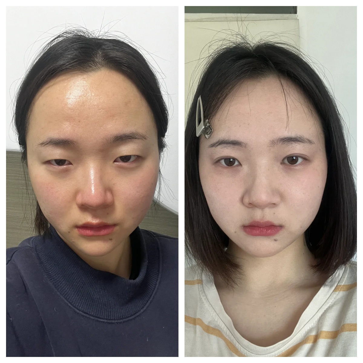 为什么双眼皮变成了单眼皮