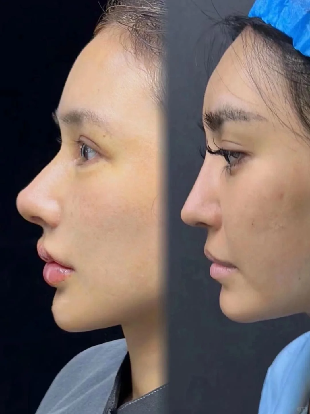 假体移位,排异,透光等问题频发,修复难度大且奥" 对比图隆鼻对比图片