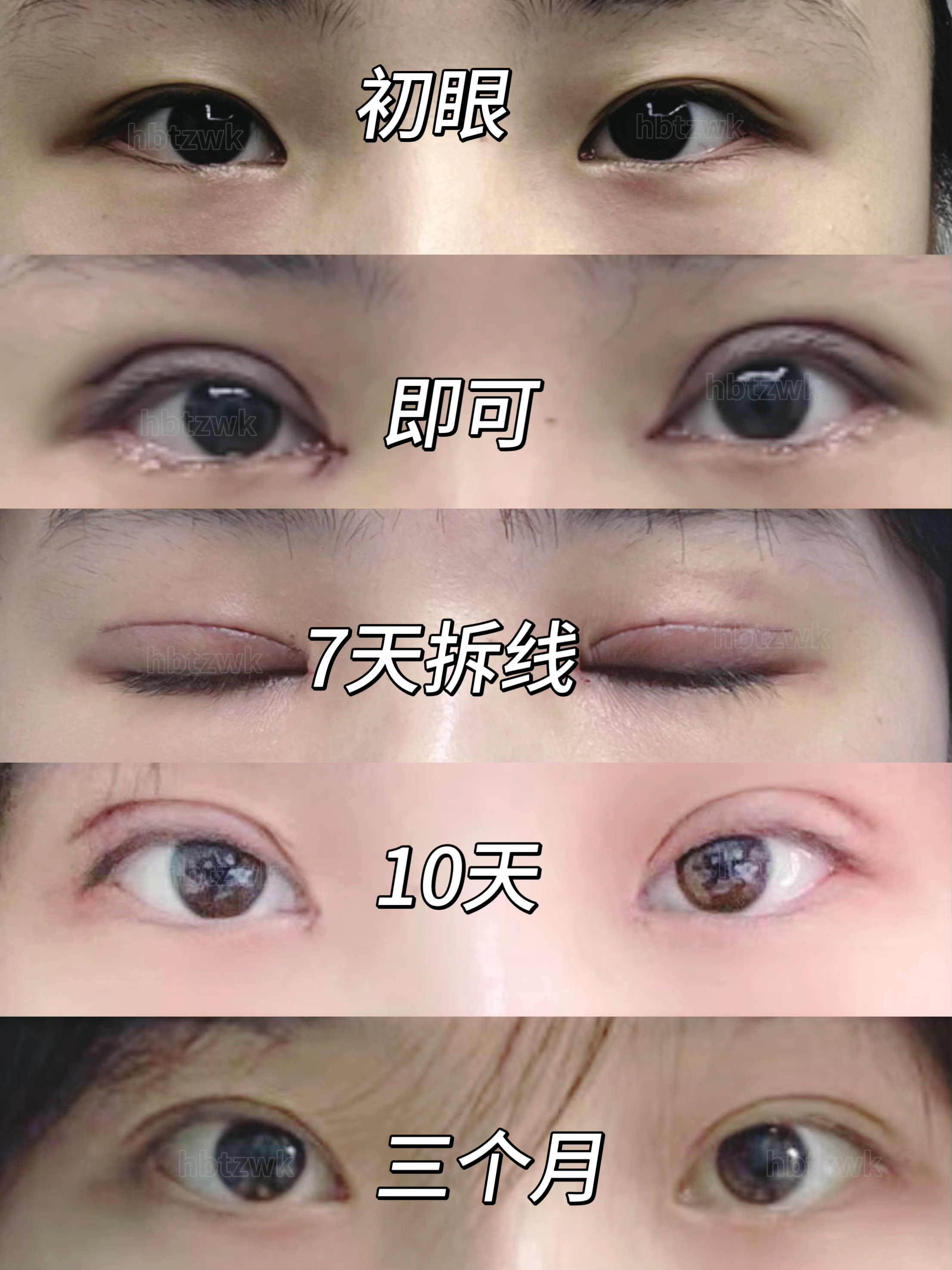 术后即刻的改变,7天拆线的期待,10天的恢复,到三