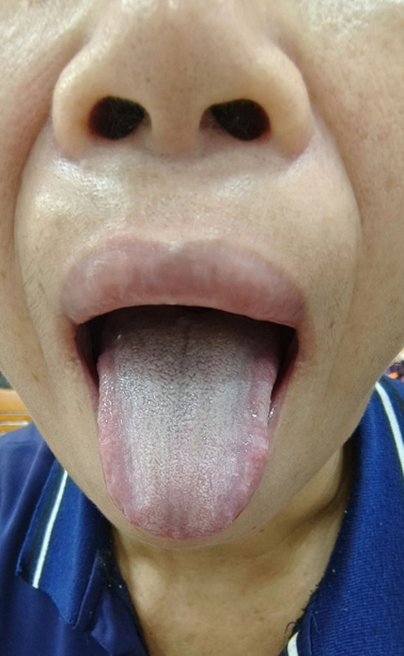 整体舌头暗紫,嘴唇也发乌发暗,结合舌下脉络也是比