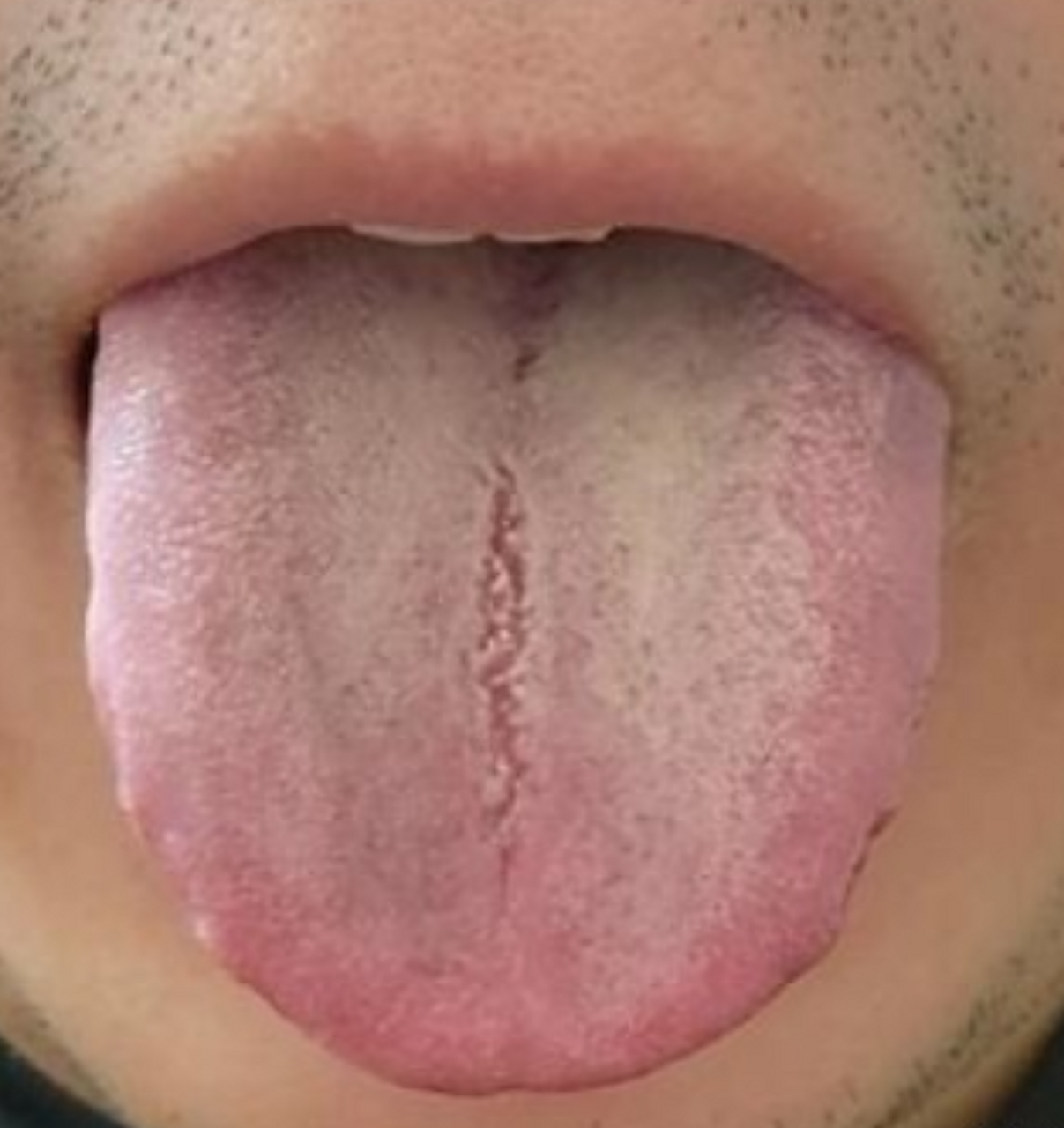 舌中裂纹,舌苔厚腻,看似是脾虚,但是不要上来就健脾,要不然也是白白