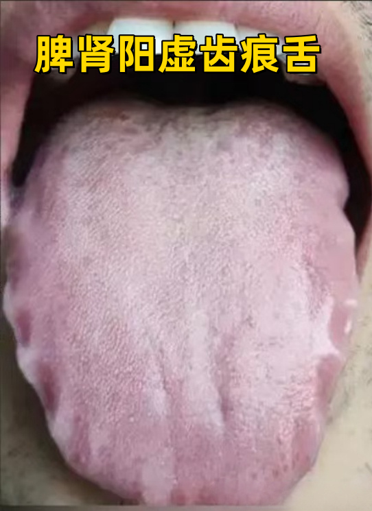 真实病因 调理方案,一次讲明白 1,脾肾阳虚型齿痕舌
