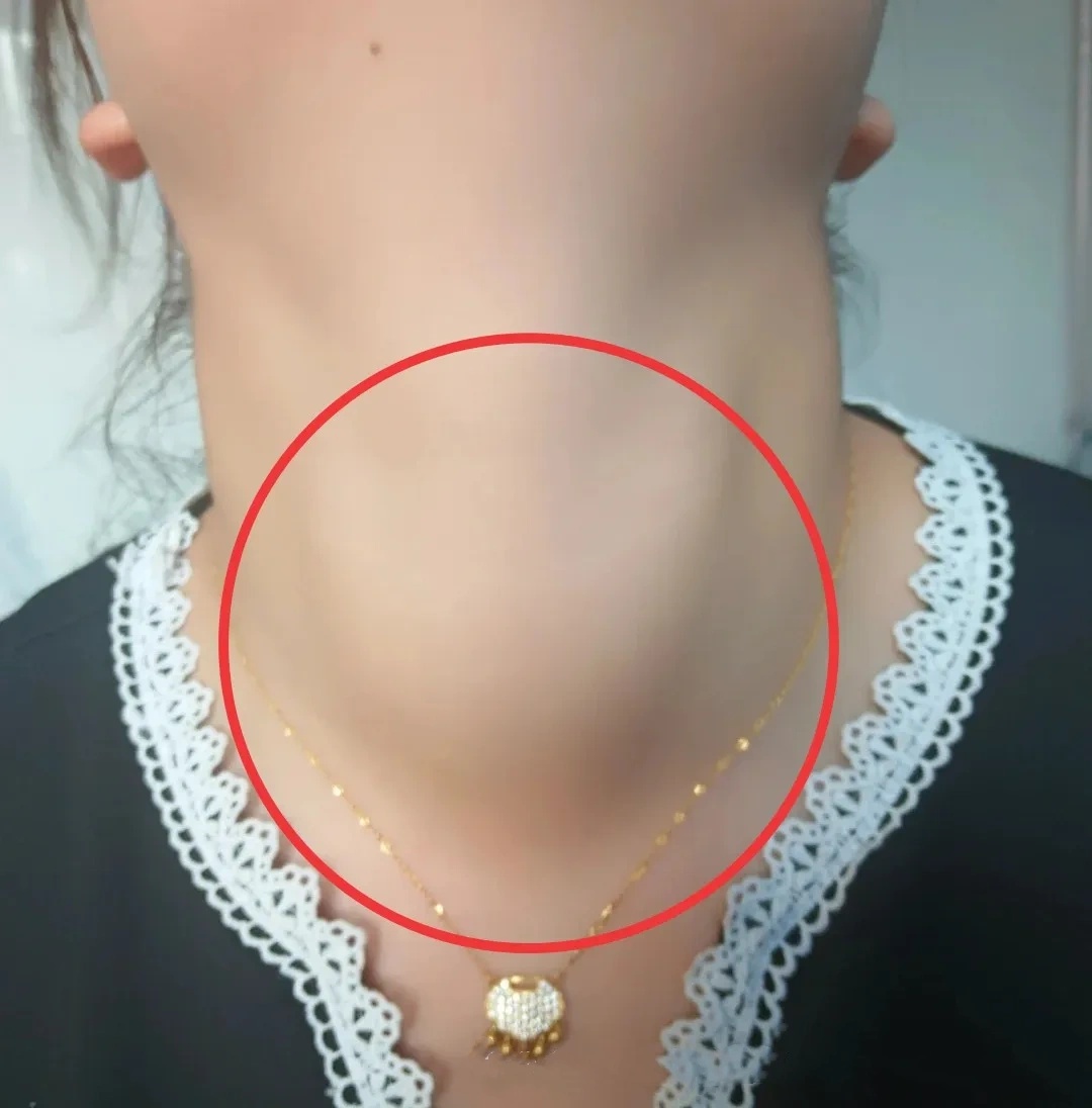 甲状腺肿大需要手术吗?