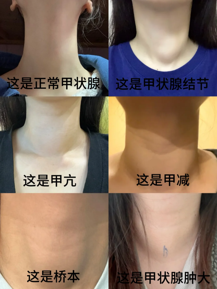 2 甲亢(甲状腺功能亢进) 肝火旺盛,气机逆乱