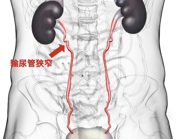 输尿管狭窄的原因有多种,主要包括以下几个方面: 1