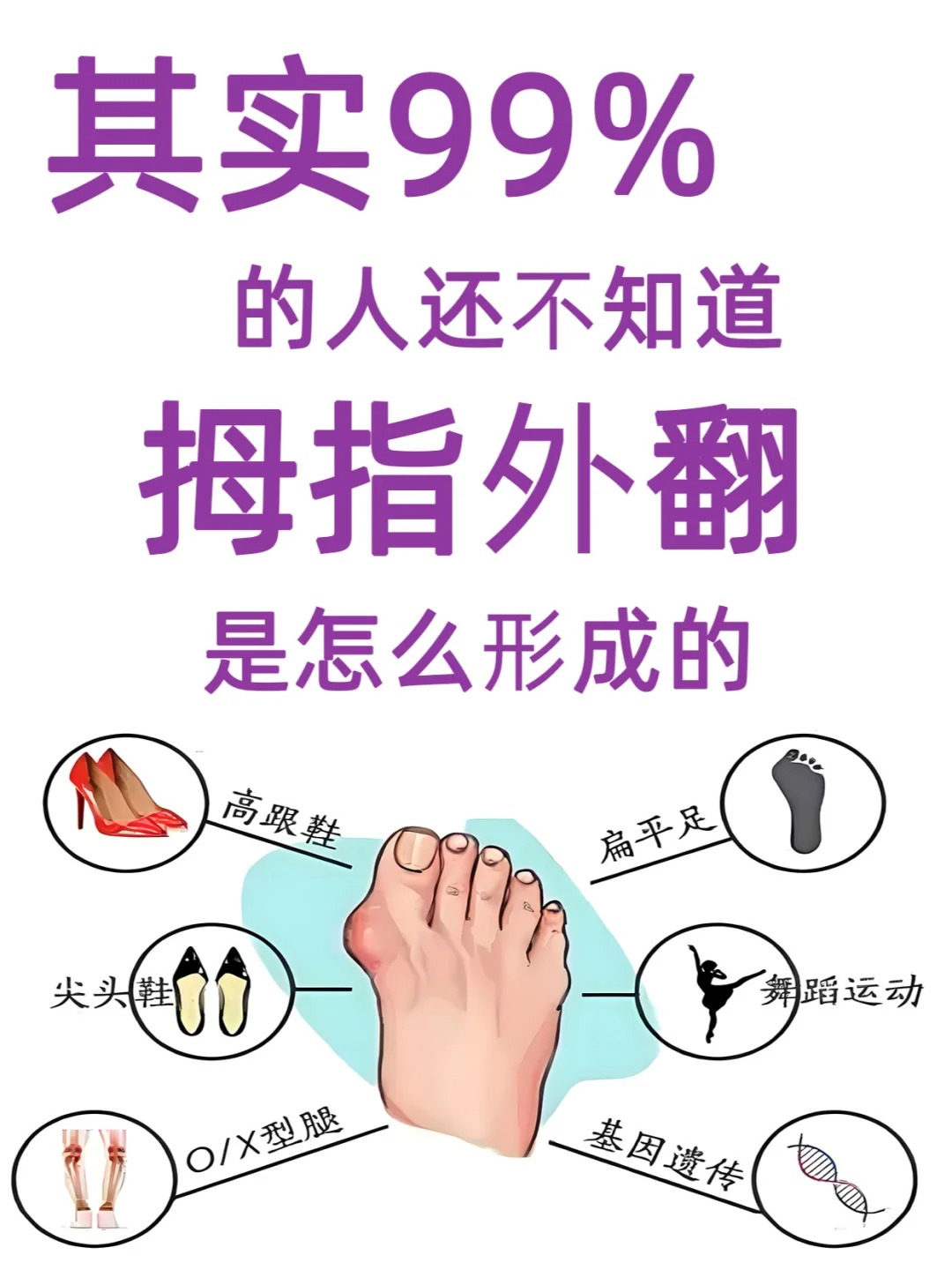 长期穿高跟鞋,尖头鞋,会挤压脚趾,增加患病风险.