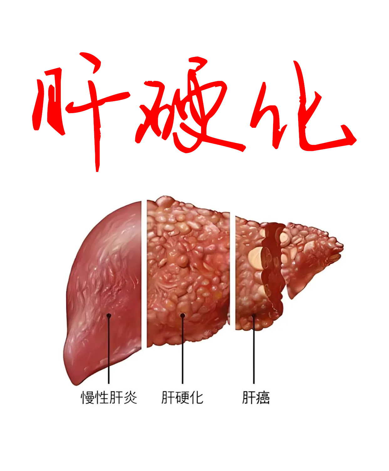 门诊上经常有二三十岁的乙肝患者因拖延导致病情发展至肝硬化,近日就