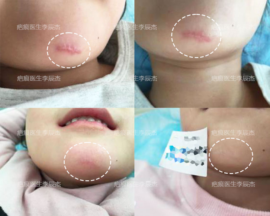 缝针#疤痕增生手术恢复图片大全下巴处圆形疤痕切除美容切除后图片