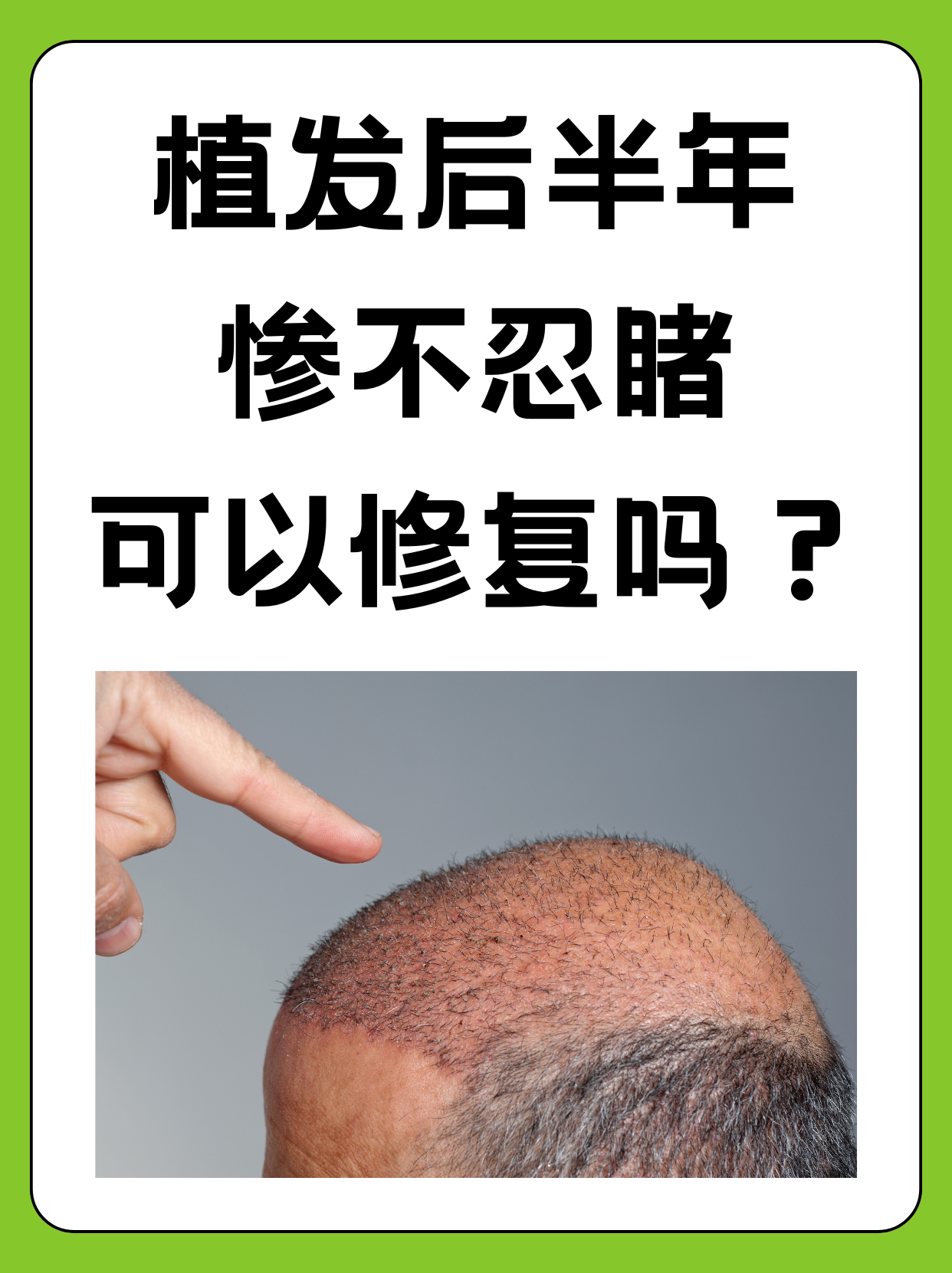 植发技术 与风险 为何不建相关图片4