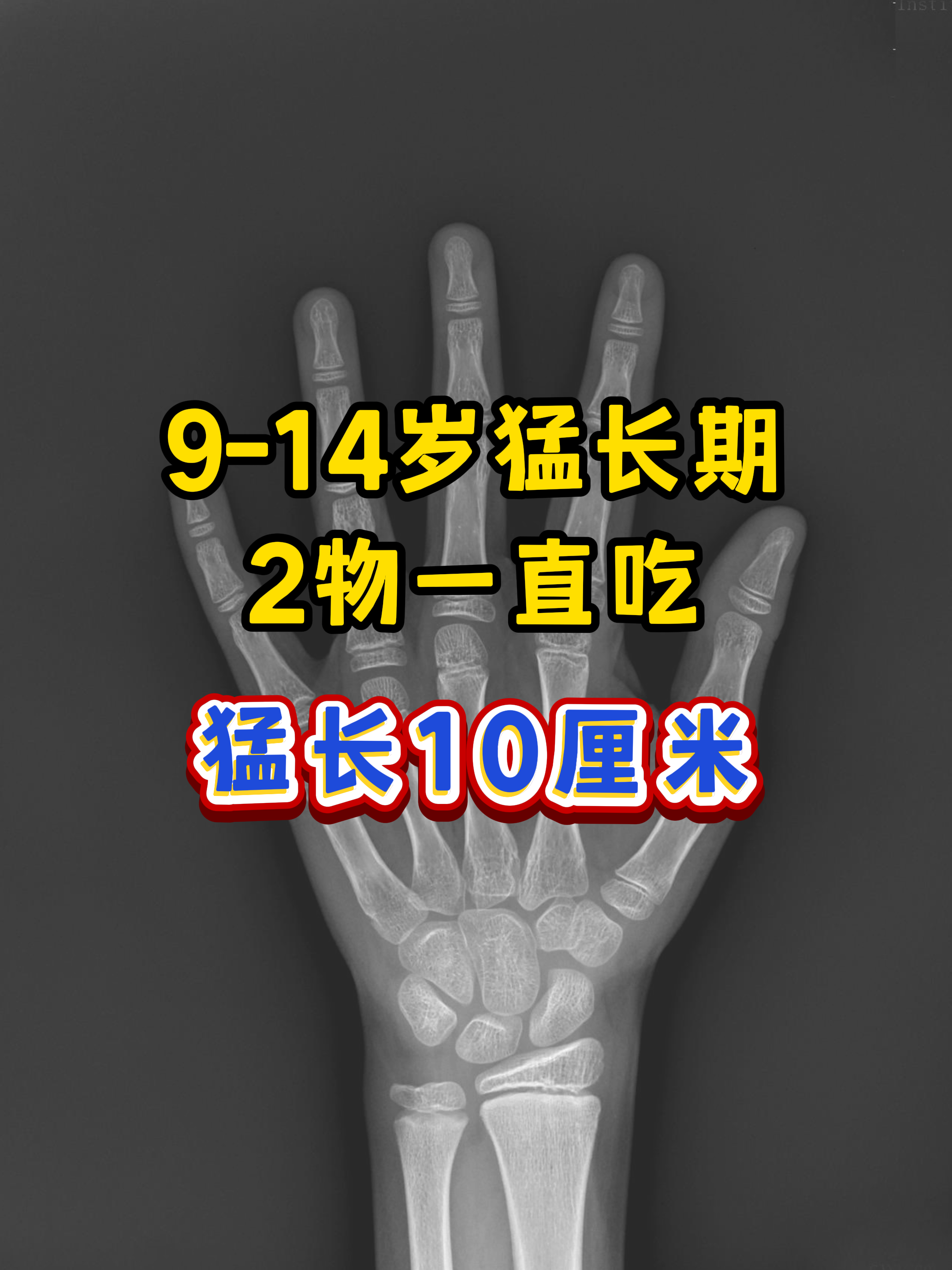 前段时间刚复诊了一个男孩12岁整了经过一年的身高干预长了10