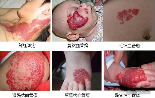 血管瘤是一种常见的良性肿瘤,主要由血管内皮细胞异常增生形成