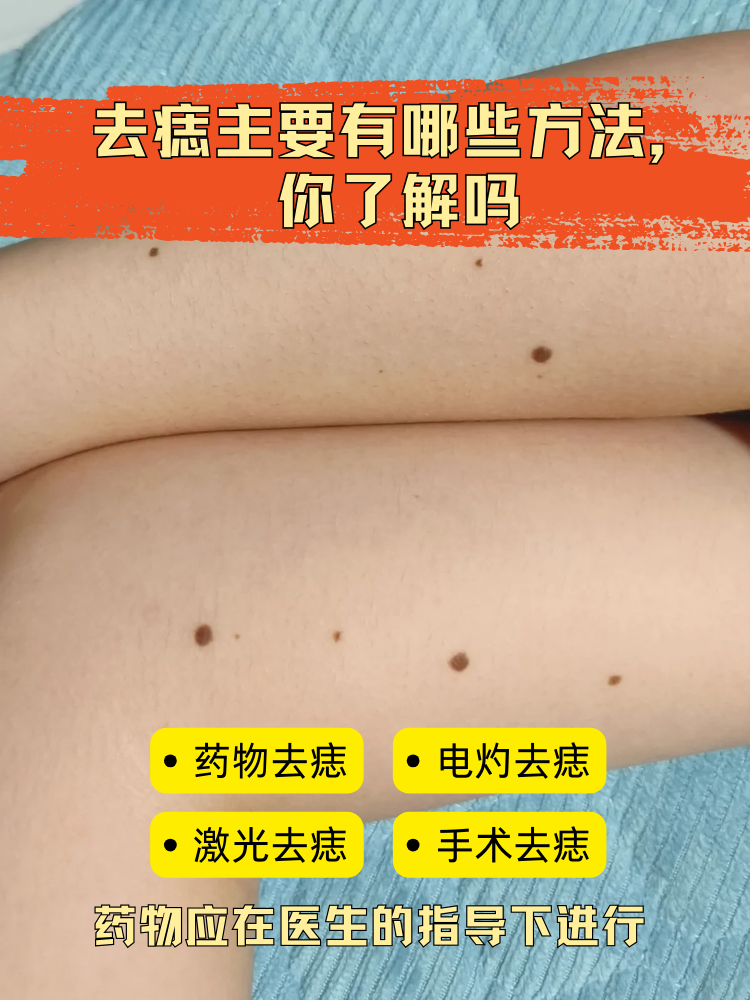 去痣主要有哪些方法,你了解吗  痣是患者身体中的黑色素细胞出现良性