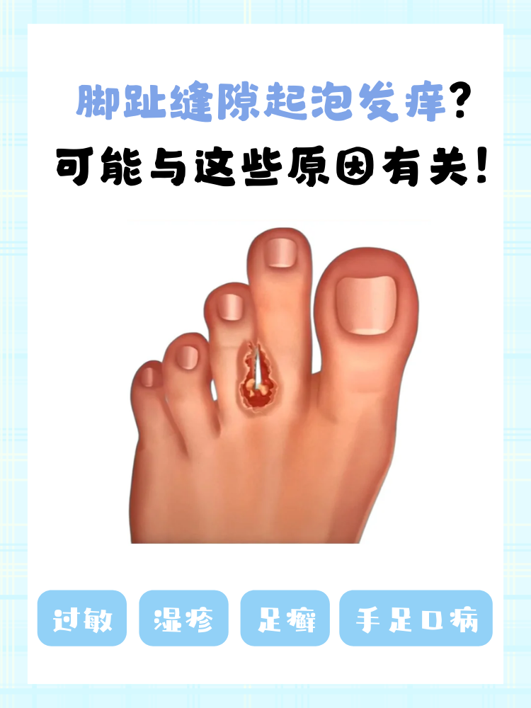 缝隙里面很痒有点烂掉皮怎么办脚趾头上起来小水泡航胖悍煜镀鹋莘⒀ ?