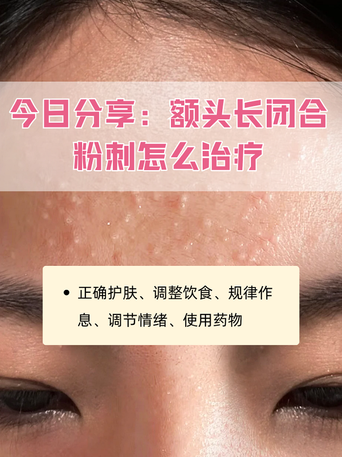 额头为什么会长粉刺闭口为什么在线