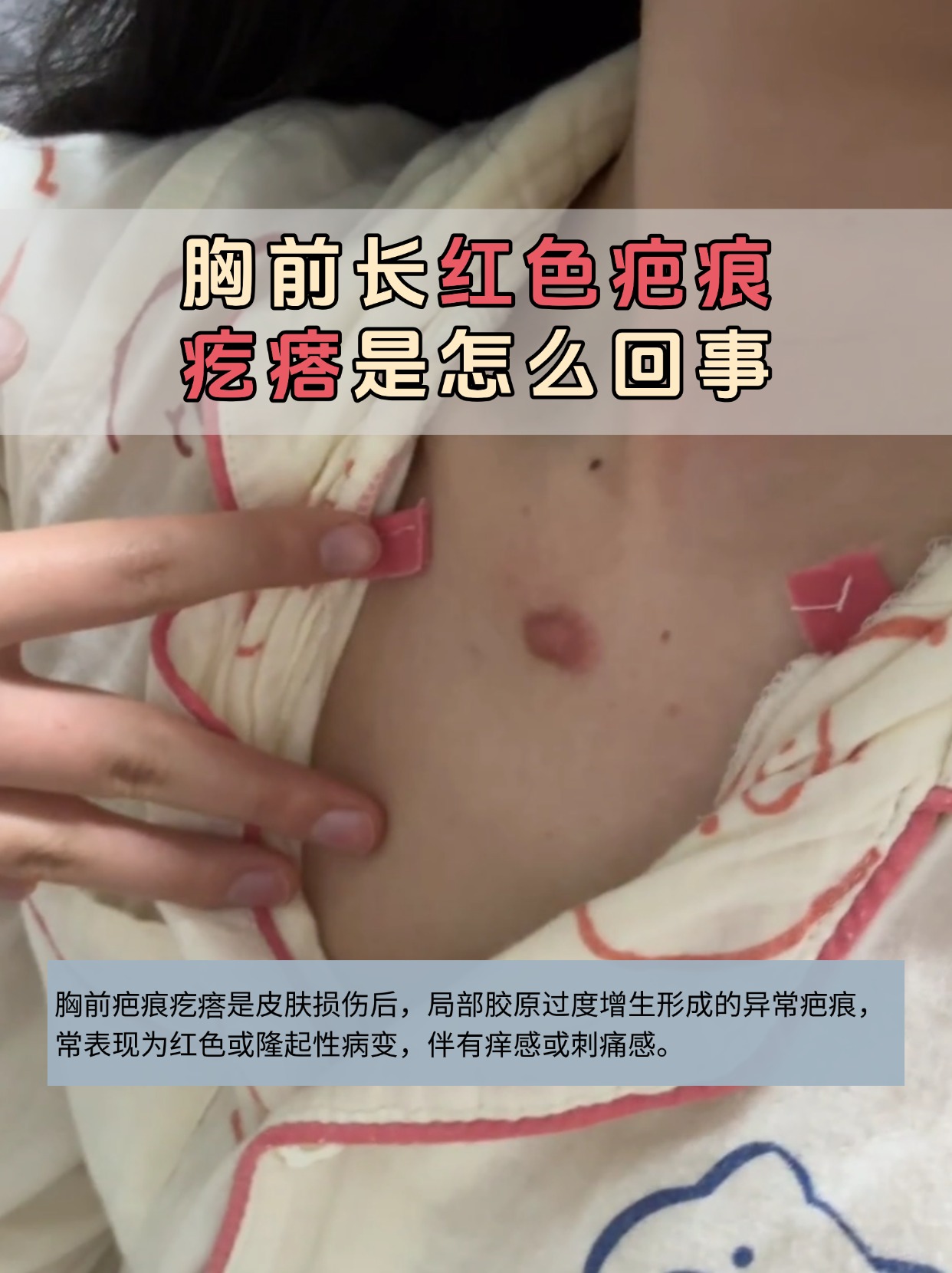 今日科普:胸前长红色疤痕疙瘩是怎么回事?