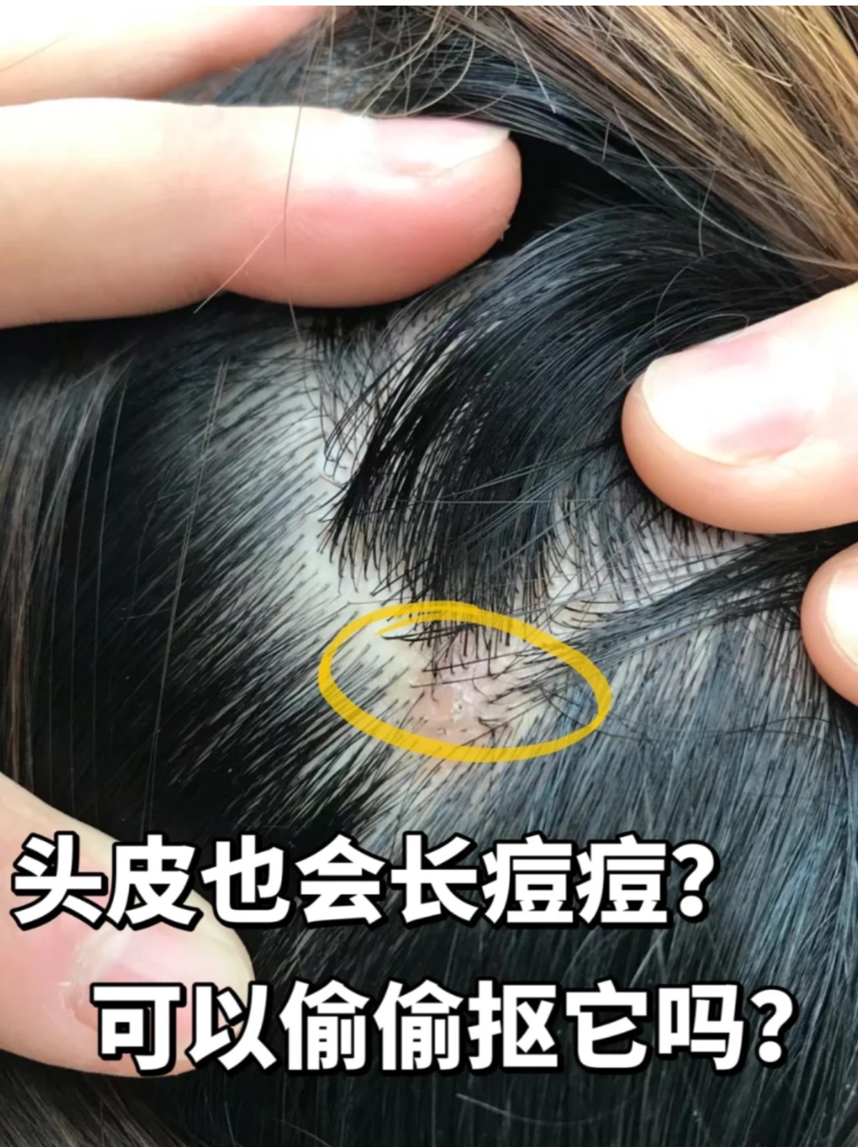 毛囊炎 原因: 毛囊被细菌(如金黄色葡萄球菌)感染 头皮毛囊炎图片