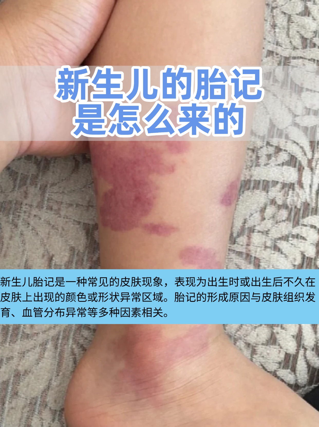 出生后会长胎记吗