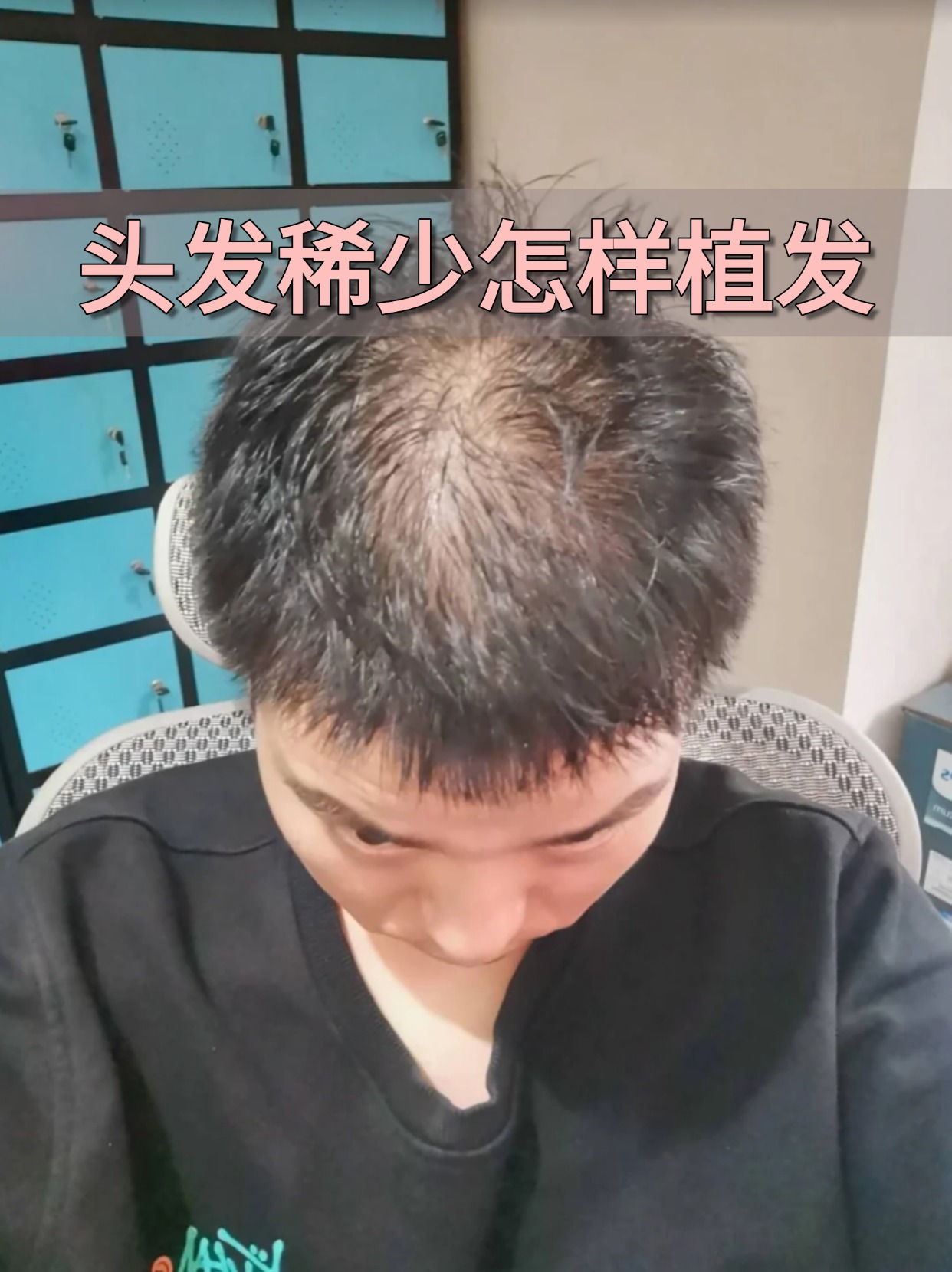今日分享头顶头发稀少怎样植发