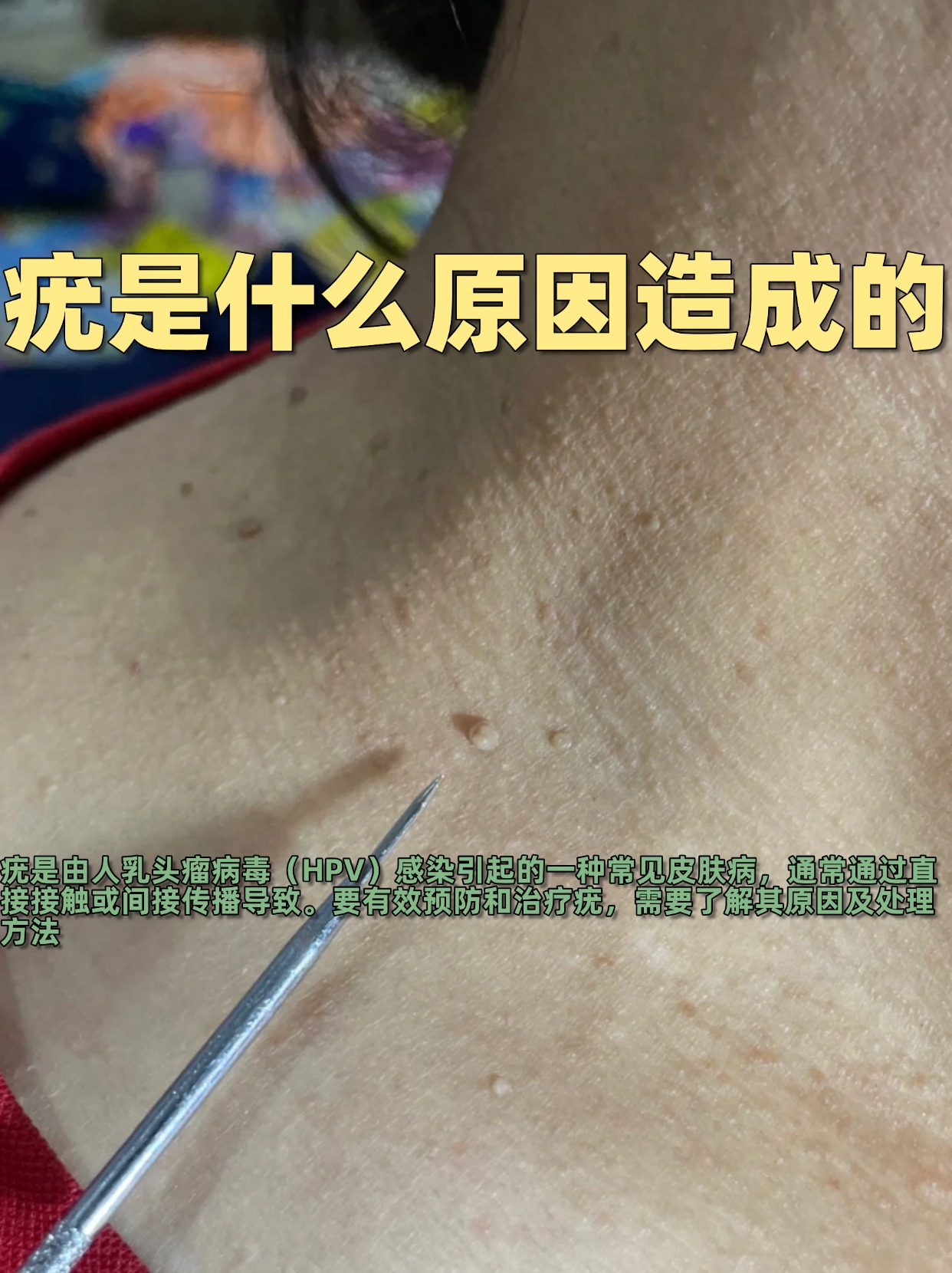 医生分享 疣是什么原因造成的  疣是由人乳头瘤病毒