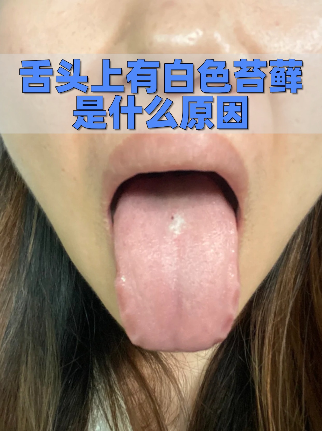 舌头上有白色苔藓是什么原因