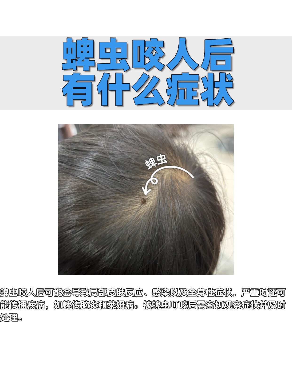 蜱虫咬人后有什么症状?
