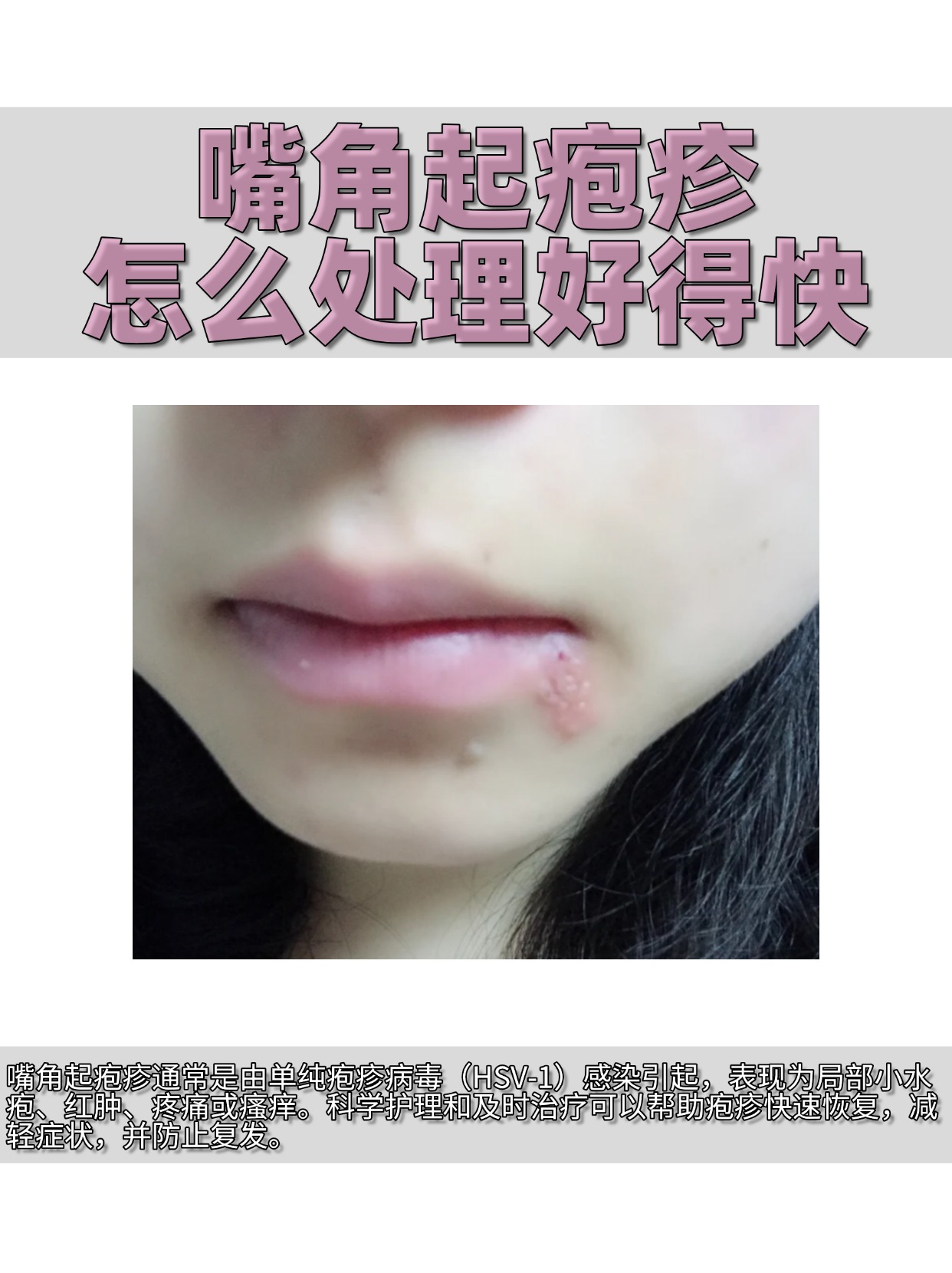 科学护理和及时治疗可以帮助疱疹快速恢复,减轻症状,并防止复发