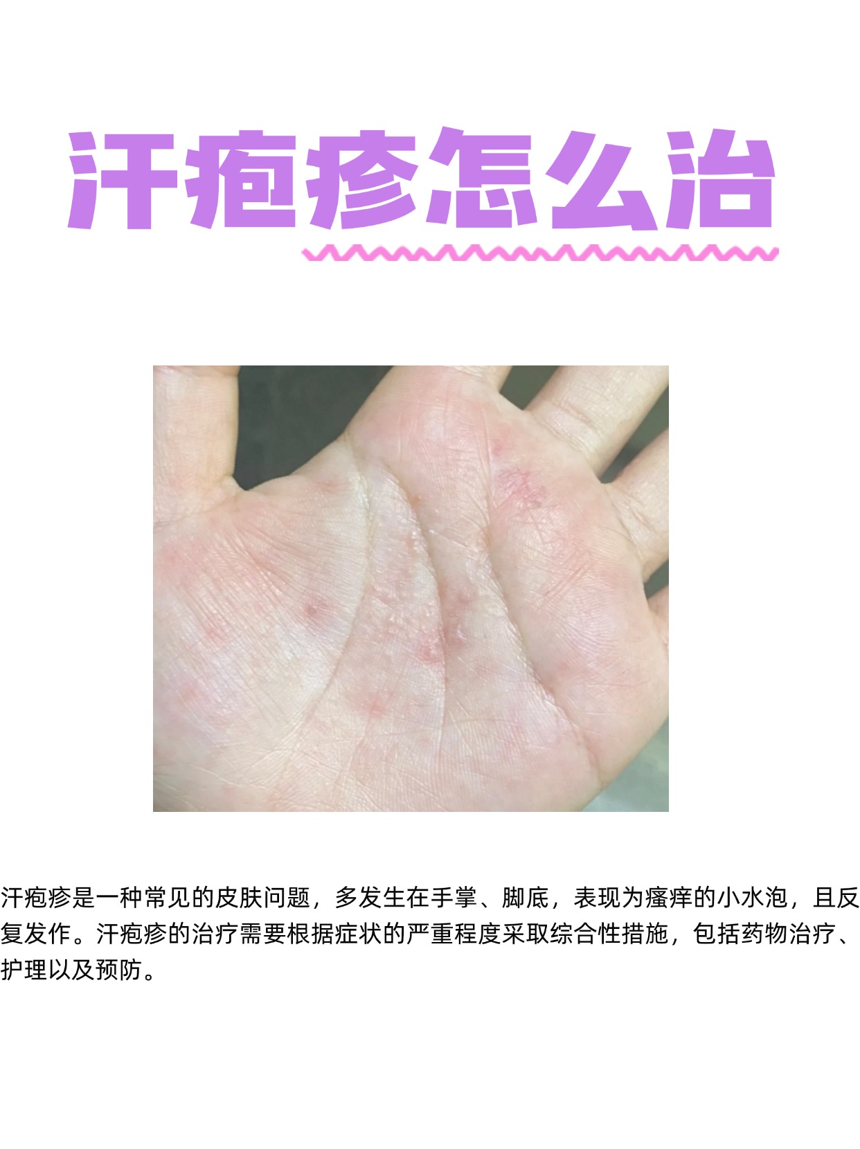 汗疱疹是一种常见的皮肤问题,多发生在手掌,脚底