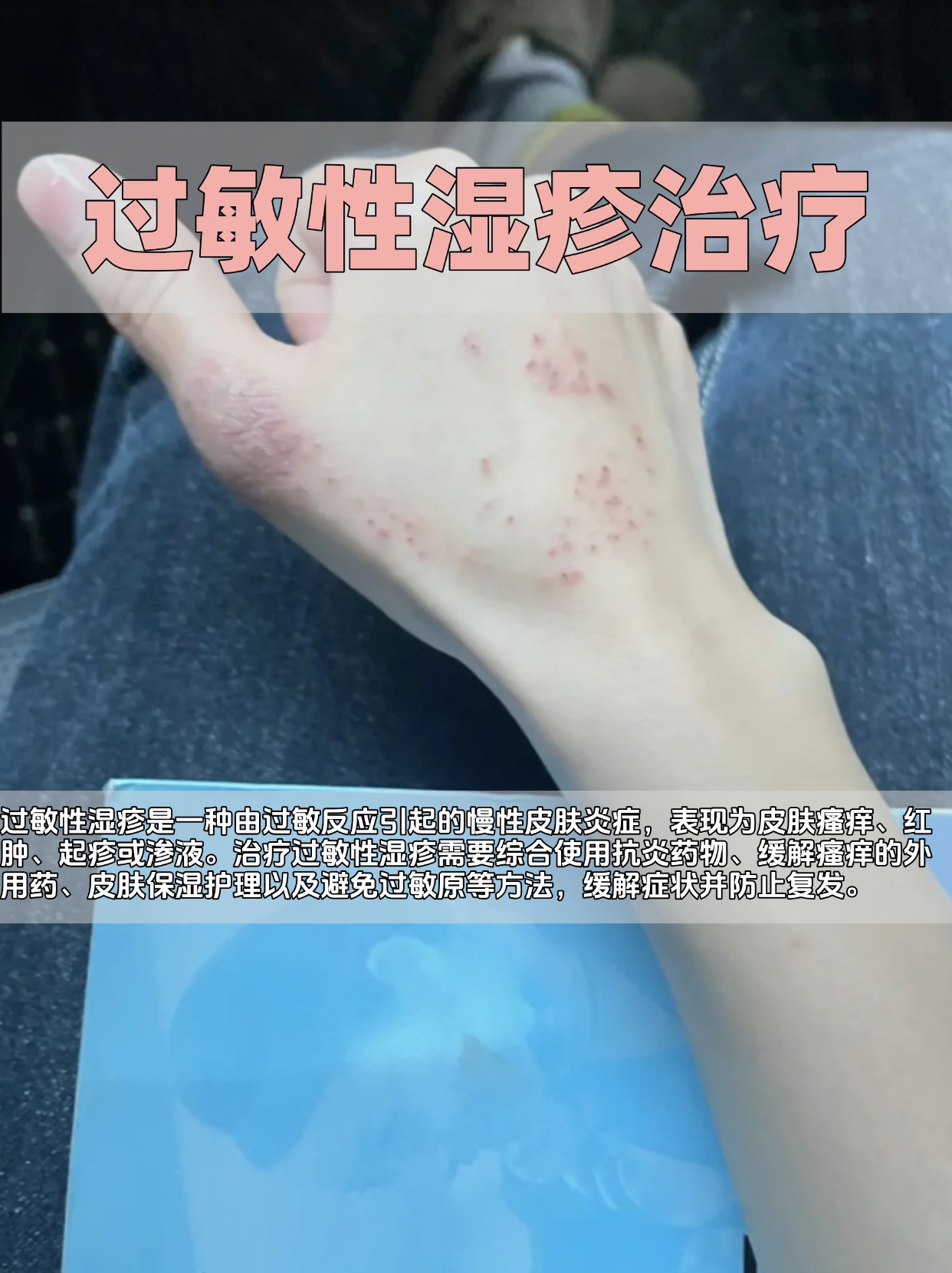 今日分享:过敏性湿疹怎么治疗