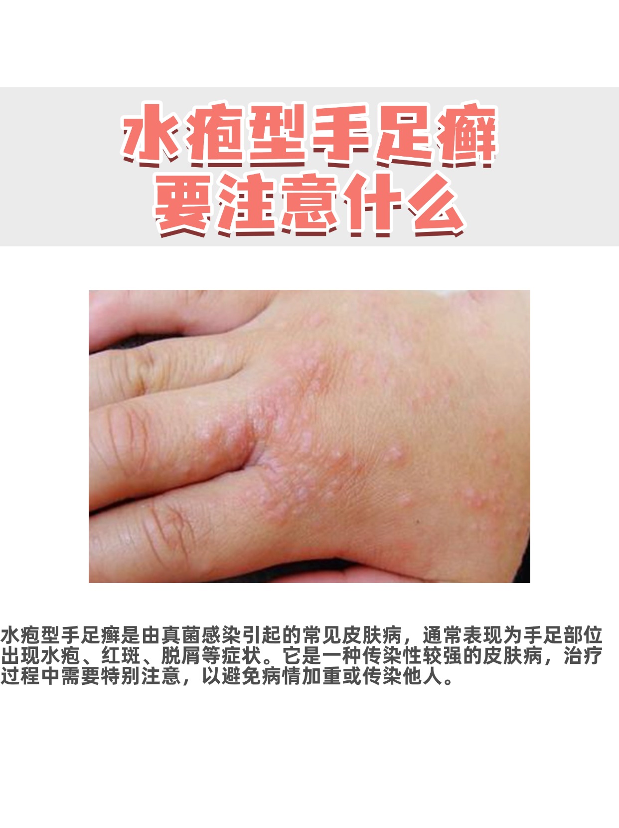 今日科普:水疱型手足癣需要注意什么