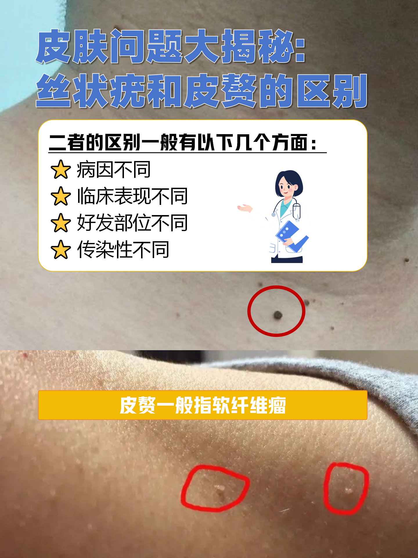 皮肤软纤维瘤怎么治疗图片