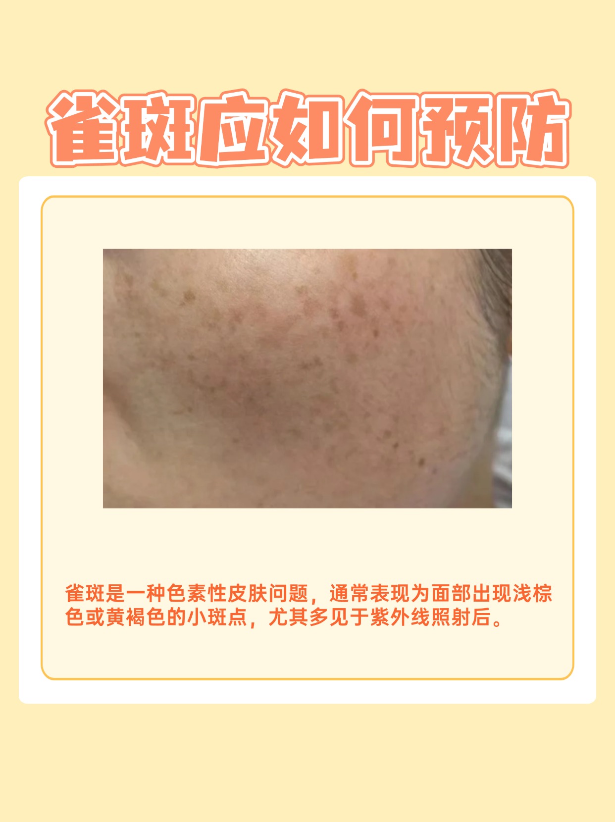 颜色的图片斑点皮肤问题皮肤老化长褐色斑点块状浅褐色不规则面部的