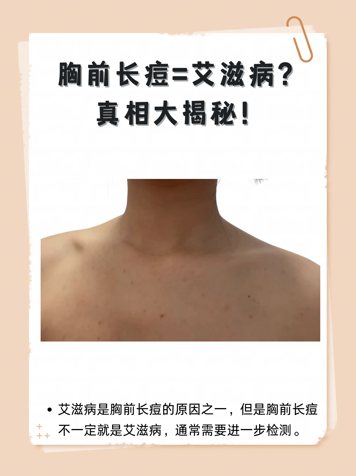 胸前长痘=艾滋病?真相大揭秘!