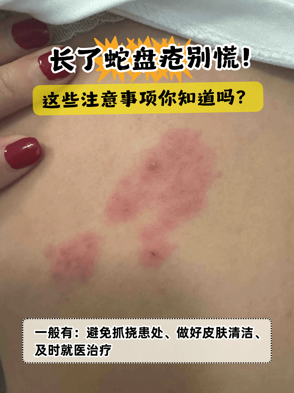 蛇盘疮在医学上是指带状疱疹