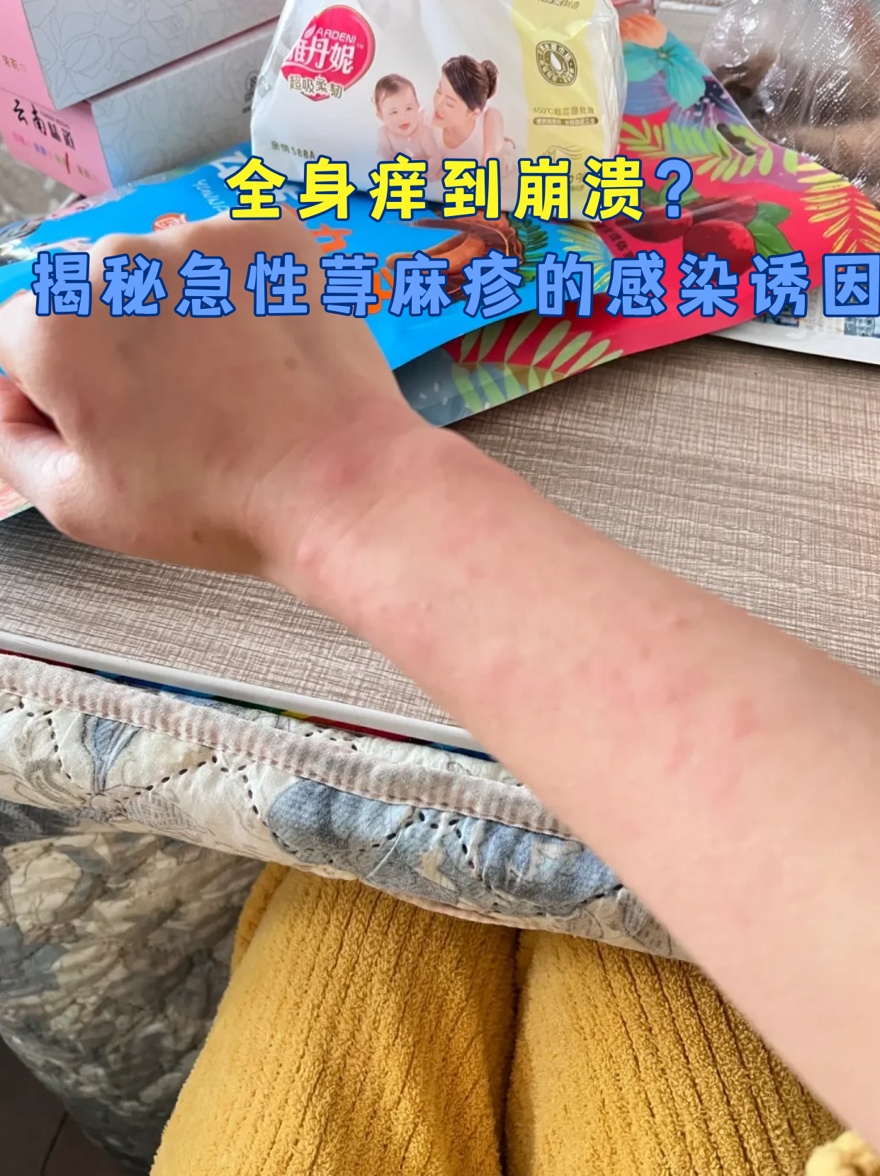 为什么会荨麻疹以前没有过为什么在线