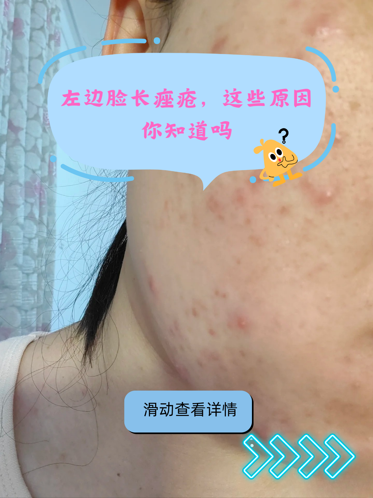 为什么突然冒痘痘 为什么突然冒痘痘