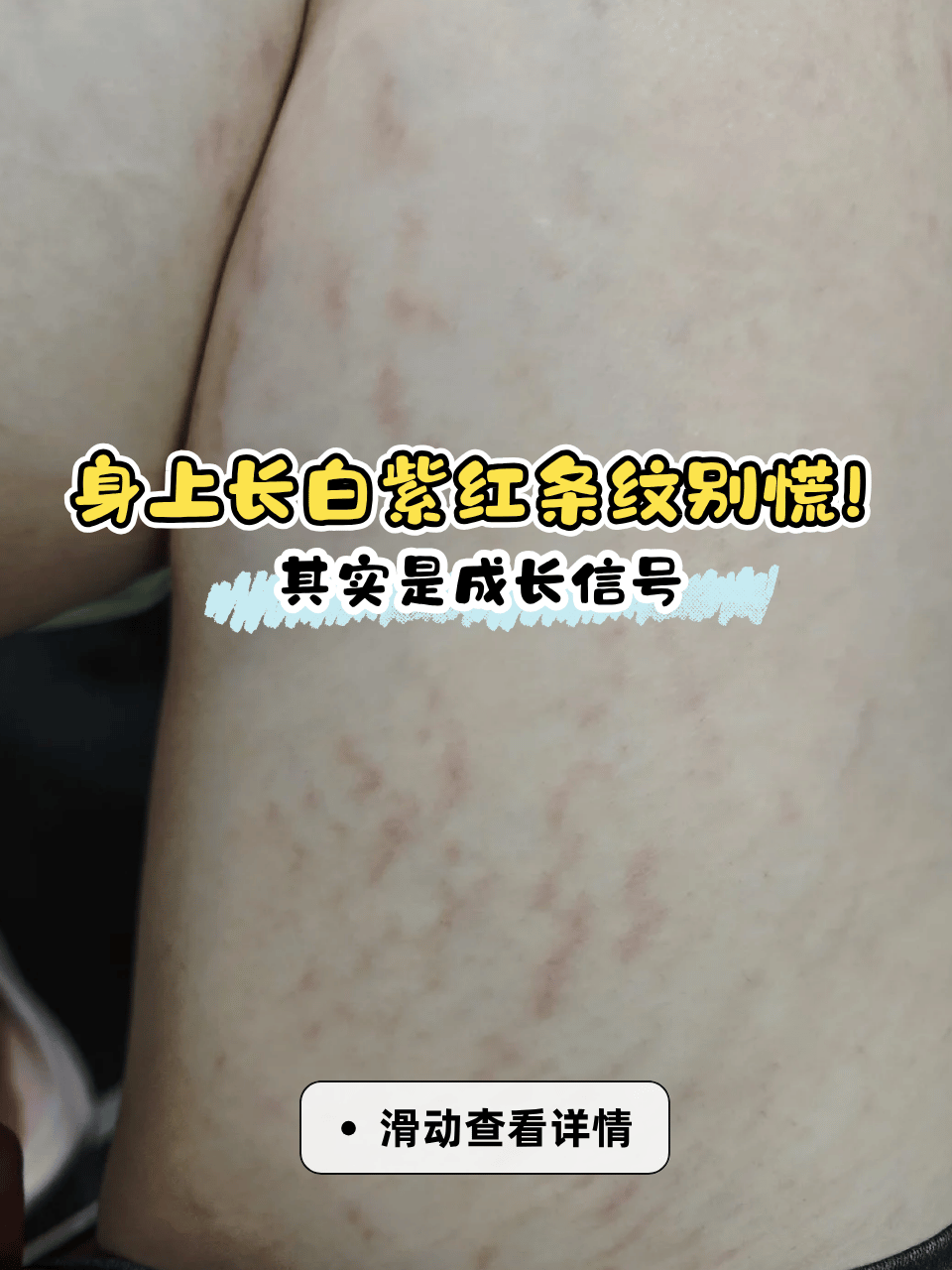 紫纹图片库欣紫纹图片萎缩纹14岁小腿后面有花斑怎么回事白色膨胀纹