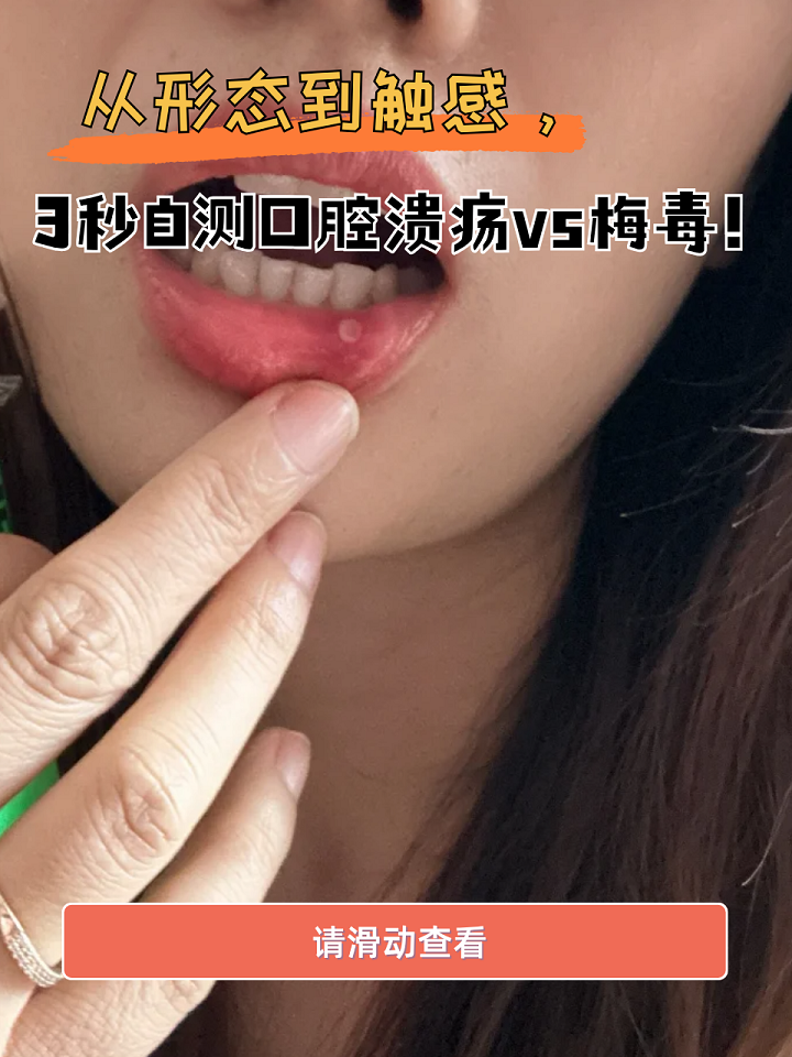 梅毒和口腔溃疡的症状易混淆,但可快速自测